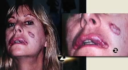 The woman wey do "Do-It-Yourself" plastic surgery for em face and wey end up deformed 